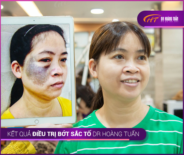 Kết quả điều trị bớt sắc tố tại Thẩm mỹ Hoàng Tuấn